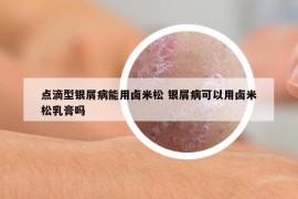 點(diǎn)滴型銀屑病能用鹵米松 銀屑病可以用鹵米松乳膏嗎