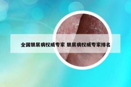 全國(guó)銀屑病權(quán)威專家 銀屑病權(quán)威專家排名