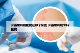 濟(jì)南銀屑病醫(yī)院在那個(gè)位置 濟(jì)南銀屑病?？漆t(yī)院