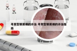 尋常型銀屑病的診治 尋常型銀屑病的診治指南