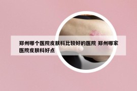 鄭州哪個醫(yī)院皮膚科比較好的醫(yī)院 鄭州哪家醫(yī)院皮膚科好點