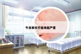 牛皮癬光療越來越嚴重