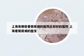上海有哪些看銀屑病的醫(yī)院比較好的醫(yī)院 上?？淬y屑病的醫(yī)生