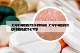 上海華山醫(yī)院皮膚科銀屑病 上海華山醫(yī)院皮膚科銀屑病知名專家