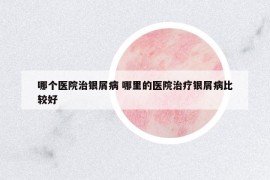 哪個(gè)醫(yī)院治銀屑病 哪里的醫(yī)院治療銀屑病比較好