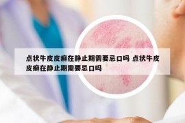 點狀牛皮皮癬在靜止期需要忌口嗎 點狀牛皮皮癬在靜止期需要忌口嗎