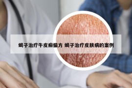 蝎子治療牛皮癬偏方 蝎子治療皮膚病的案例