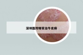 深圳醫(yī)院哪家治牛皮癬