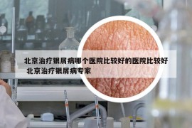 北京治療銀屑病哪個(gè)醫(yī)院比較好的醫(yī)院比較好 北京治療銀屑病專家