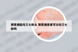 銀屑病能吃三七粉么 銀屑病患者可以吃三七粉嗎