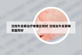沈陽(yáng)牛皮癬治療哪里比較好 沈陽(yáng)治牛皮屑哪家醫(yī)院好