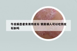 牛皮癬患者食用鐵皮石 銀屑病人可以吃鐵皮石斛嗎