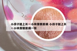 小孩子腿上長(zhǎng)一小塊像銀屑病 小孩子腿上長(zhǎng)一小塊像銀屑病一樣