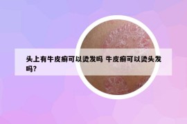 頭上有牛皮癬可以燙發(fā)嗎 牛皮癬可以燙頭發(fā)嗎?