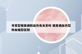 尋常型銀屑病和血熱有關(guān)系嗎 銀屑病血熱型和血燥型區(qū)別