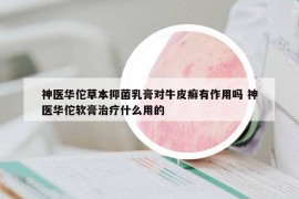 神醫(yī)華佗草本抑菌乳膏對(duì)牛皮癬有作用嗎 神醫(yī)華佗軟膏治療什么用的