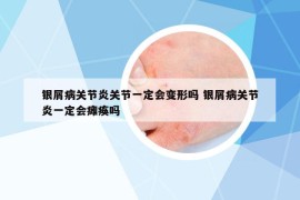 銀屑病關(guān)節(jié)炎關(guān)節(jié)一定會變形嗎 銀屑病關(guān)節(jié)炎一定會癱瘓嗎