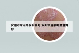 安陽市專治牛皮癬偏方 安陽銀屑病哪里治得好