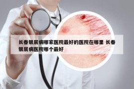 長春銀屑病哪家醫(yī)院最好的醫(yī)院在哪里 長春銀屑病醫(yī)院哪個最好