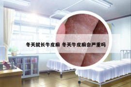 冬天就長牛皮癬 冬天牛皮癬會嚴重嗎