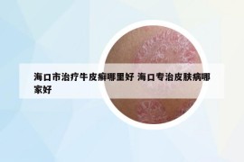 海口市治療牛皮癬哪里好 ?？趯Ｖ纹つw病哪家好