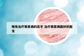 哪有治療銀屑病的高手 治療銀屑病最好的醫(yī)生