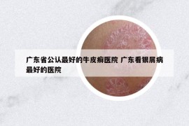 廣東省公認(rèn)最好的牛皮癬醫(yī)院 廣東看銀屑病最好的醫(yī)院