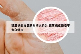 銀屑病表皮更新時(shí)間大約為 銀屑病皮損變平變白爆皮