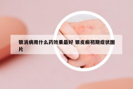 銀消病用什么藥效果最好 銀皮癬初期癥狀圖片