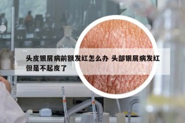 頭皮銀屑病前額發(fā)紅怎么辦 頭部銀屑病發(fā)紅但是不起皮了