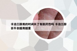 卡泊三醇用的時(shí)間長(zhǎng)了有耐藥性嗎 卡泊三醇會(huì)不會(huì)越用越重