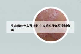 牛皮癬吃什么可控制 牛皮癬吃什么可控制病毒
