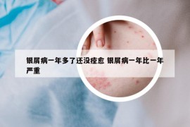 銀屑病一年多了還沒痊愈 銀屑病一年比一年嚴重