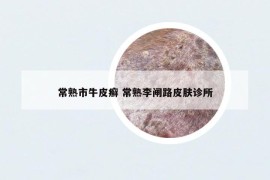 常熟市牛皮癬 常熟李閘路皮膚診所