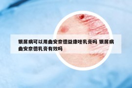 銀屑病可以用曲安奈德益康唑乳膏嗎 銀屑病曲安奈德乳膏有效嗎