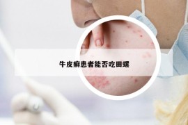 牛皮癬患者能否吃田螺