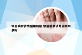 銀屑病會轉為副銀屑病 銀屑病會轉為副銀屑病嗎