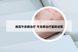 南宮牛皮癬治療 牛皮癬治療最新進展
