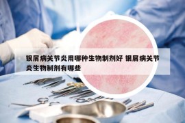 銀屑病關(guān)節(jié)炎用哪種生物制劑好 銀屑病關(guān)節(jié)炎生物制劑有哪些
