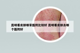 昆明看皮膚哪家醫(yī)院比較好 昆明看皮膚去哪個醫(yī)院好