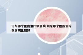 山東哪個(gè)醫(yī)院治療銀屑病 山東哪個(gè)醫(yī)院治療銀屑病比較好