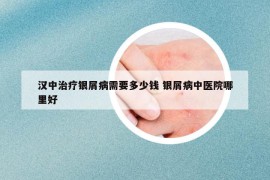漢中治療銀屑病需要多少錢 銀屑病中醫(yī)院哪里好