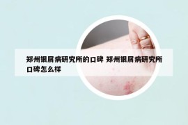 鄭州銀屑病研究所的口碑 鄭州銀屑病研究所口碑怎么樣