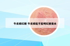 牛皮癬紅糖 牛皮癬能不能喝紅糖姜水
