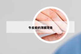 牛皮癬的薄膜現(xiàn)象
