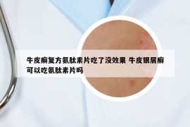 牛皮癬復(fù)方氨肽素片吃了沒效果 牛皮銀屑癬可以吃氨肽素片嗎