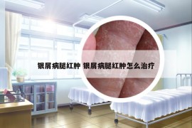 銀屑病腿紅腫 銀屑病腿紅腫怎么治療