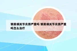 銀屑病關(guān)節(jié)炎很嚴(yán)重嗎 銀屑病關(guān)節(jié)炎很嚴(yán)重嗎怎么治療