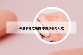 牛皮癬能吃吸粉 牛皮膚癬可以吃