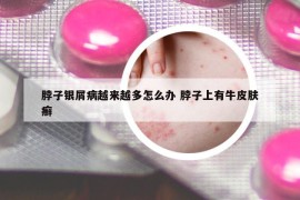 脖子銀屑病越來(lái)越多怎么辦 脖子上有牛皮膚癬